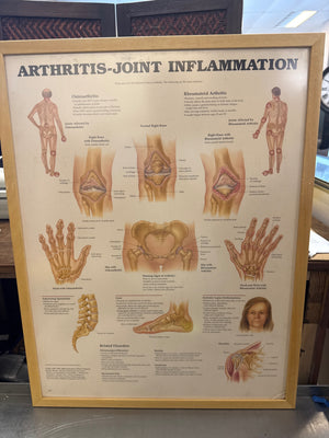 Framed Arthritis Joint Inflammation Chart Measuring 21 x 27
