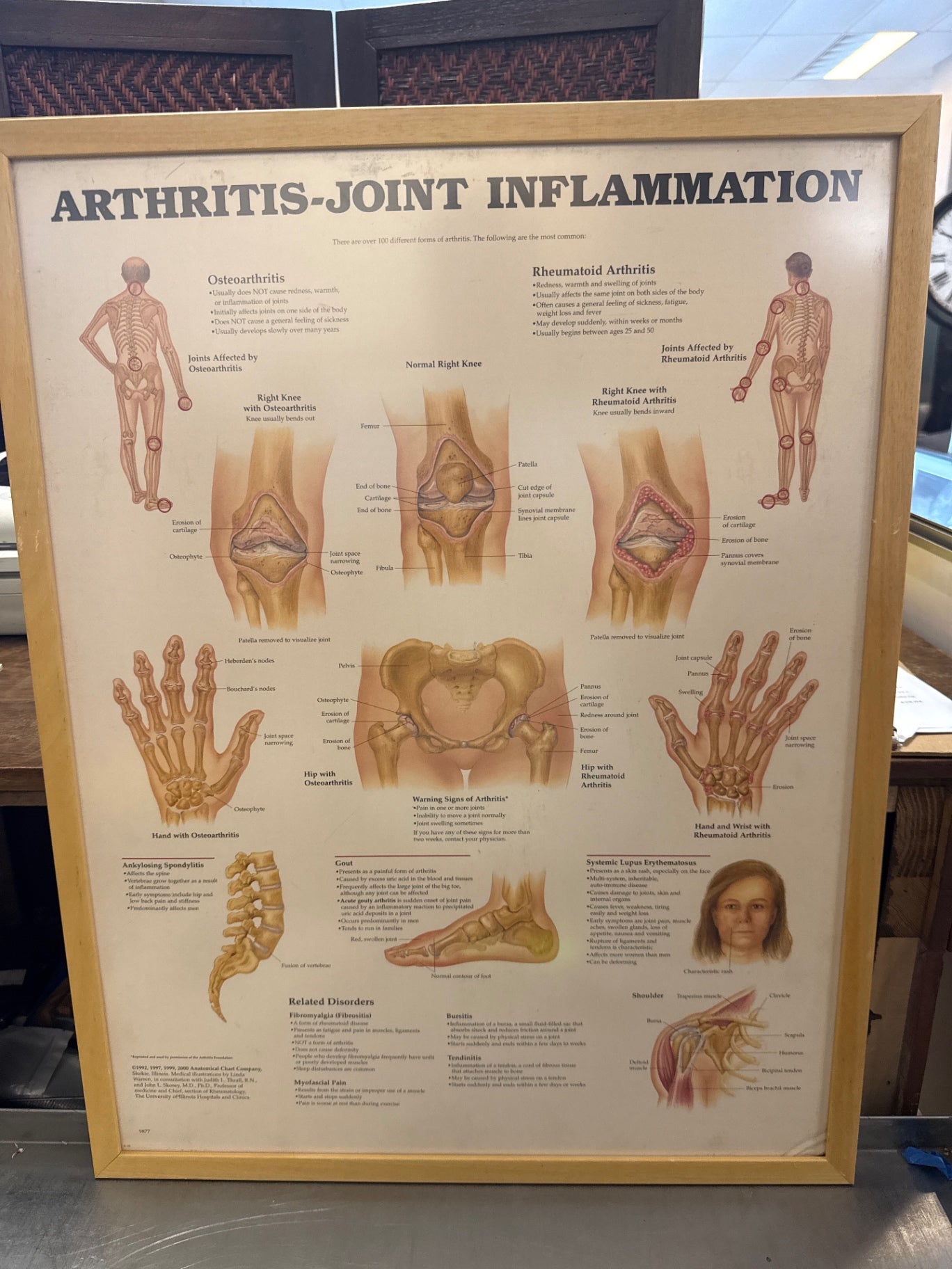 Framed Arthritis Joint Inflammation Chart Measuring 21 x 27