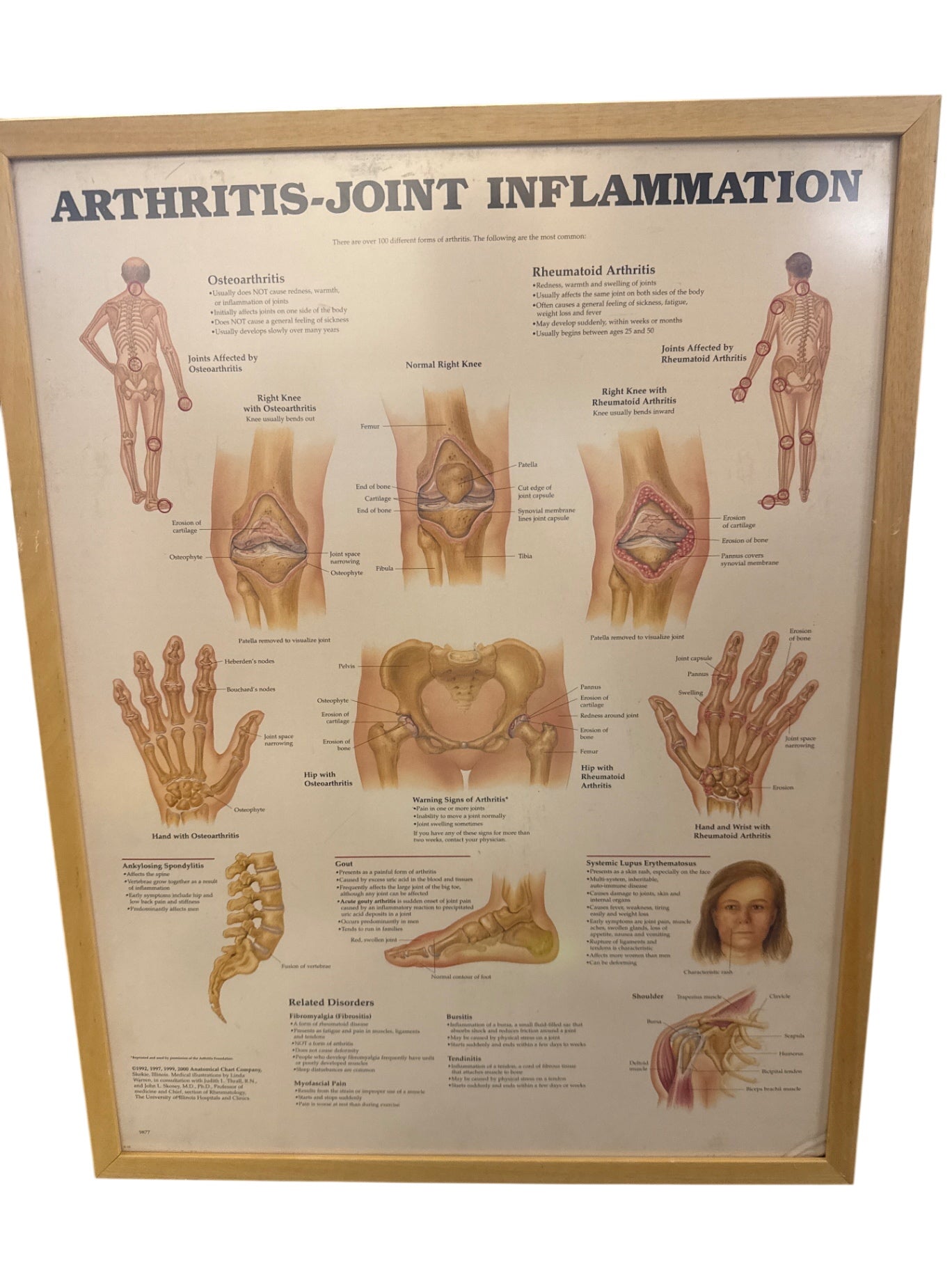 Framed Arthritis Joint Inflammation Chart Measuring 21 x 27